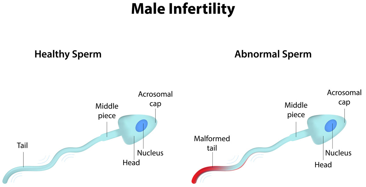 the-growing-problem-of-male-infertility-alldaychemist-health-blog