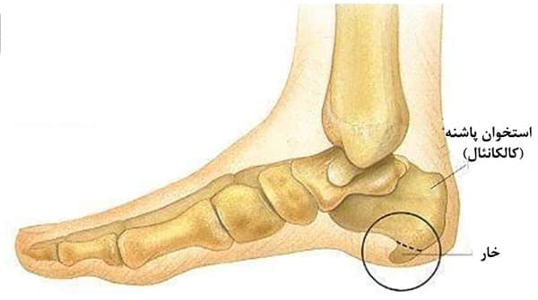 چرا شاکویو برای درمان خار پاشنه مؤثر است؟