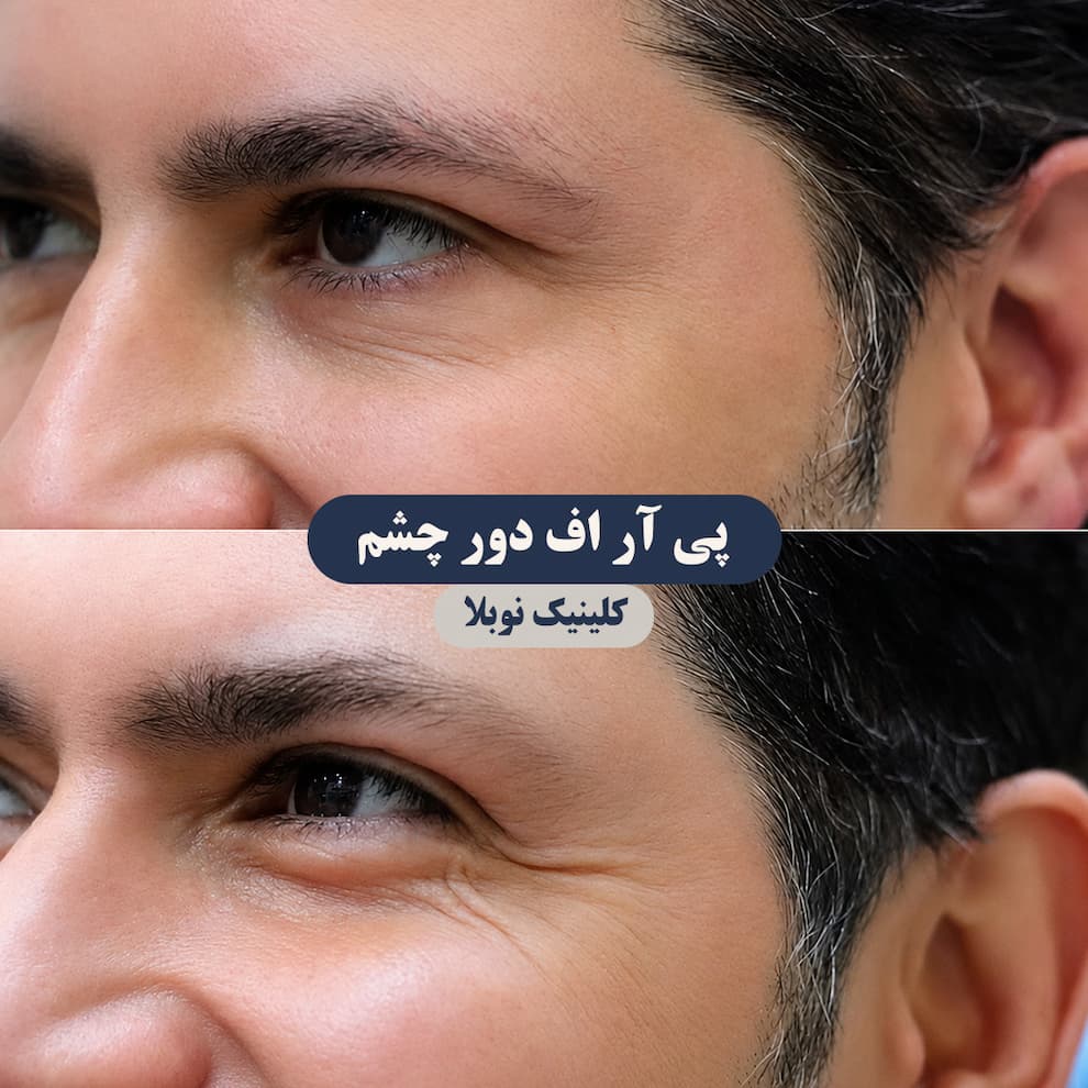 prf چیست