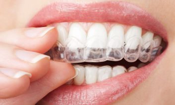 علت و روش‌های درمانی دندان‌قروچه