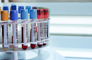یک آزمایش ساده خون برای پیش‌بینی بازگشت دوباره سرطان خون