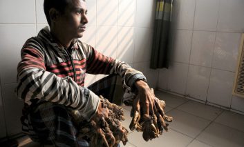 رخدادهای نادر پزشکی: مرد درختی
