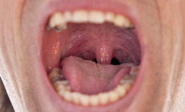 تورم زبان کوچک: علل، علائم، درمان