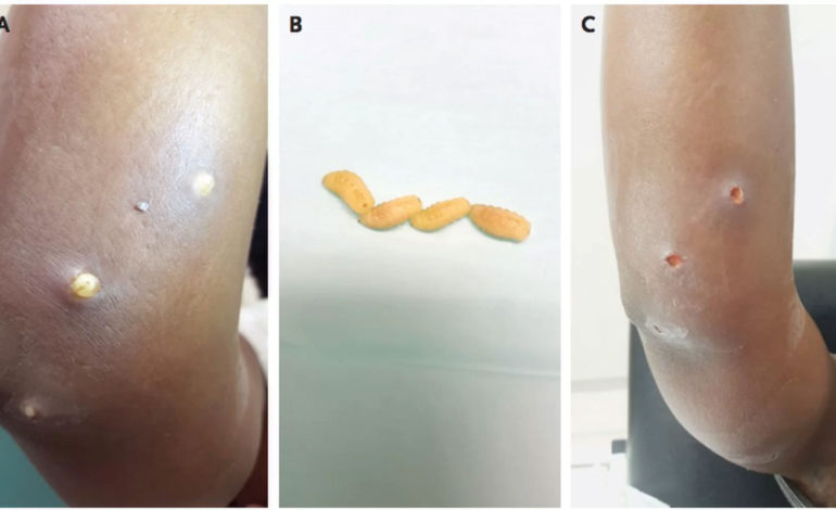 رخدادهای نادر پزشکی: تخم‌گذاری مگس در پوست انسان
