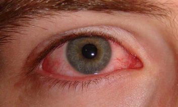 ۱۰ درمان خانگی برای برطرف کردن التهابات آلرژیک چشم
