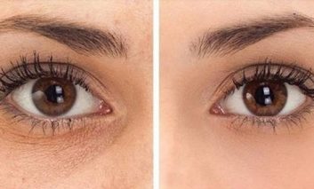 چه چیزهایی باید در مورد کوکتل مزوتراپی بدانیم؟