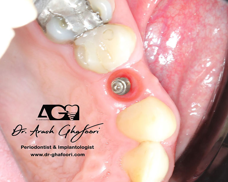 کاشت دندان،دکتر آرش غفوری