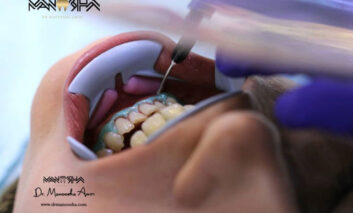 حقایق عجیب بلیچینگ دندان به نقل از دکتر مانوشا امیری