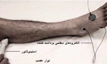 نوار عصب و عضله برای تشخیص آسیب‌ های عضلات و عصب های دست و پا