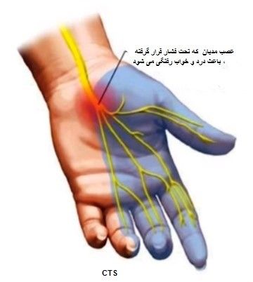 تفسیر نوار عصب و عضله دست