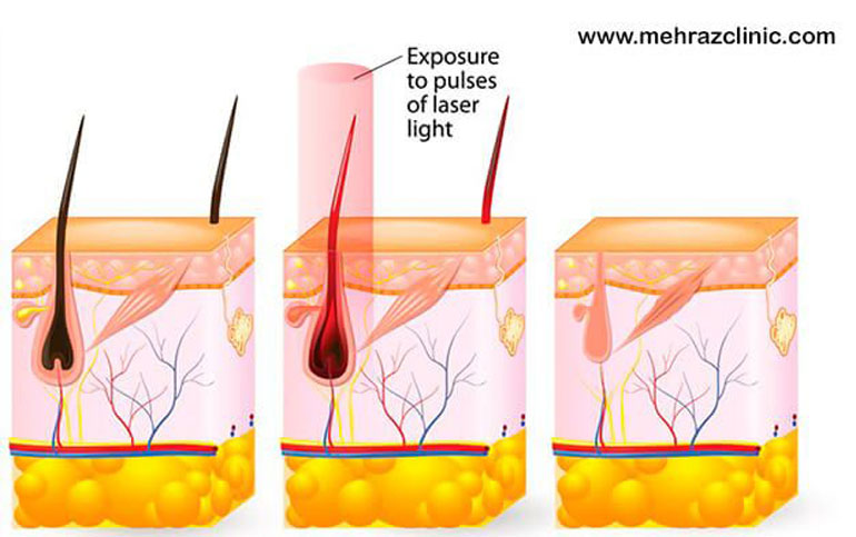 عملکرد لیزر موهای زائد