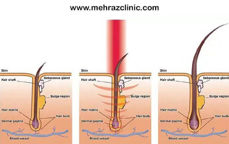 خطرات و عوارض لیزر 