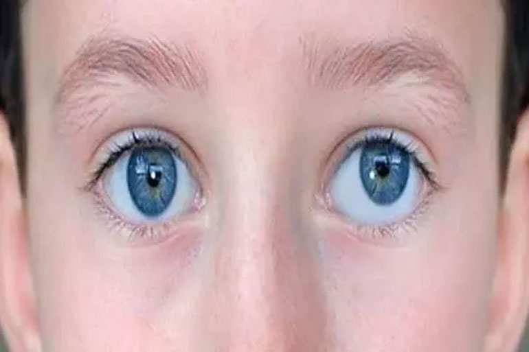 قرمزی چشم یکی از بیماری های رایج چشم است که عوامل مختلفی می تواند داشته باشد.