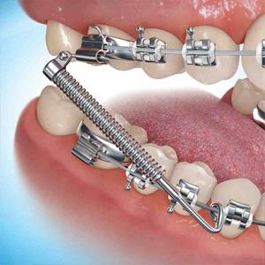 اصطلاحات ارتودنسی دندان