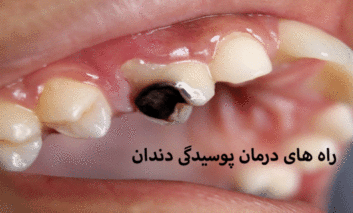 چند راه ساده برای درمان پوسیدگی دندان
