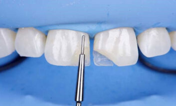 مراقبت های لازم بعد از کامپوزیت دندان