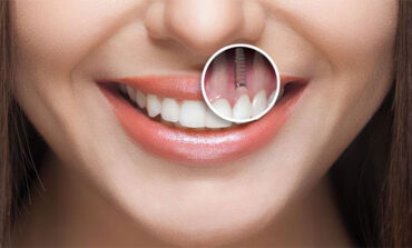 مشاوره آنلاین ایمپلنت از طریق واتساپ - کلینیک دندانپزشکی ایده آل