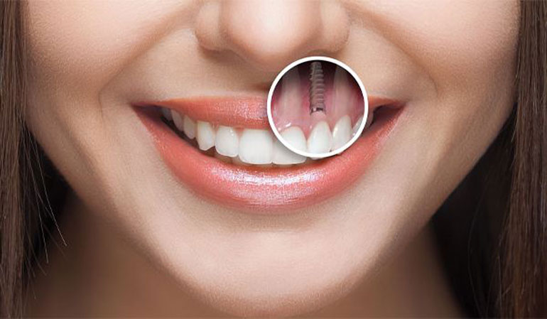 مشاوره آنلاین ایمپلنت از طریق واتساپ – کلینیک دندانپزشکی ایده آل