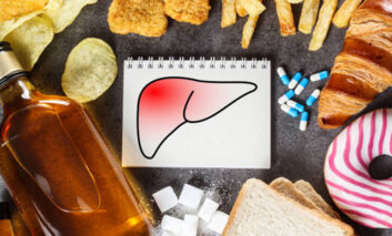 بیماری کبد چرب غیر الکلی (NAFLD) چیست؟ + درمان فیبروز و سیروز