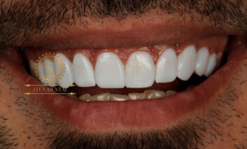 کامپوزیت در دندانپزشکی آتن