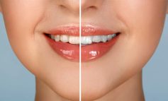 برای سفید کردن دندان‌ها درمان خانگی یا حرفه‌ای بهتر است؟