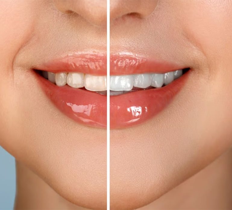 برای سفید کردن دندان‌ها درمان خانگی یا حرفه‌ای بهتر است؟