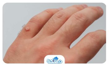 زگیل غیرتناسلی چیست؟