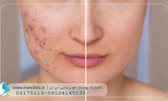 مهمترین نکاتی که برای لیزر جای جوش باید رعایت کنیم