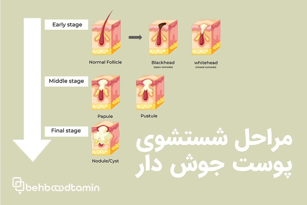 مراحل شستشوی پوست جوش دار