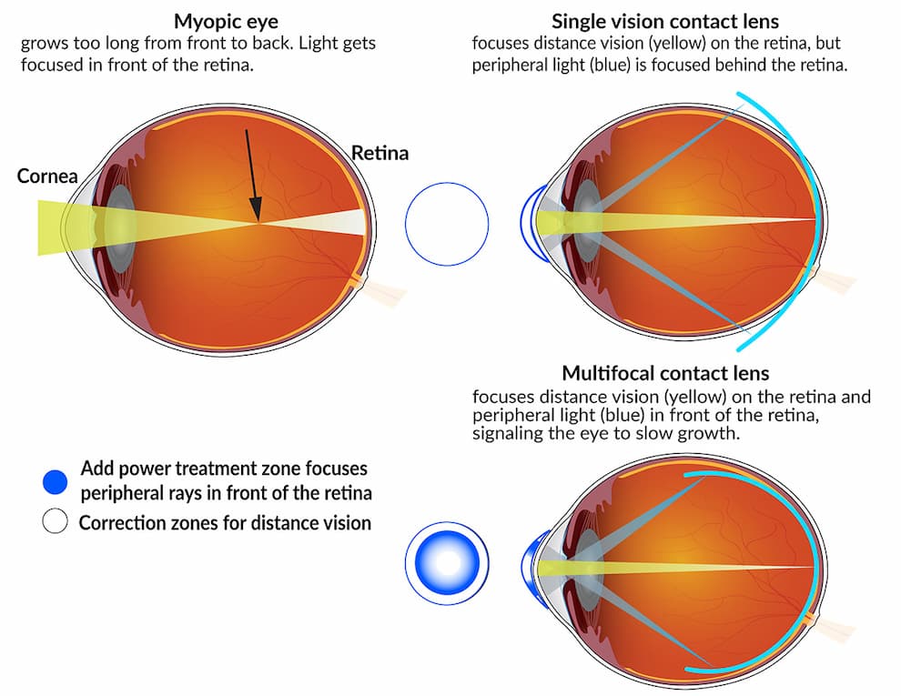 یک چشم نزدیک‌بین بیش از حد از جلو به عقب رشد می‌کند. نور در جلوی شبکیه متمرکز می‌شود.