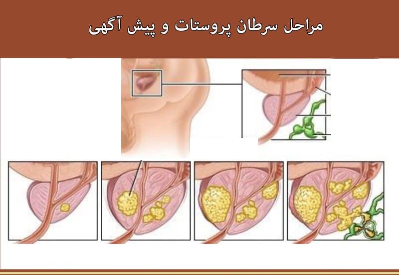 مراحل سرطان پروستات