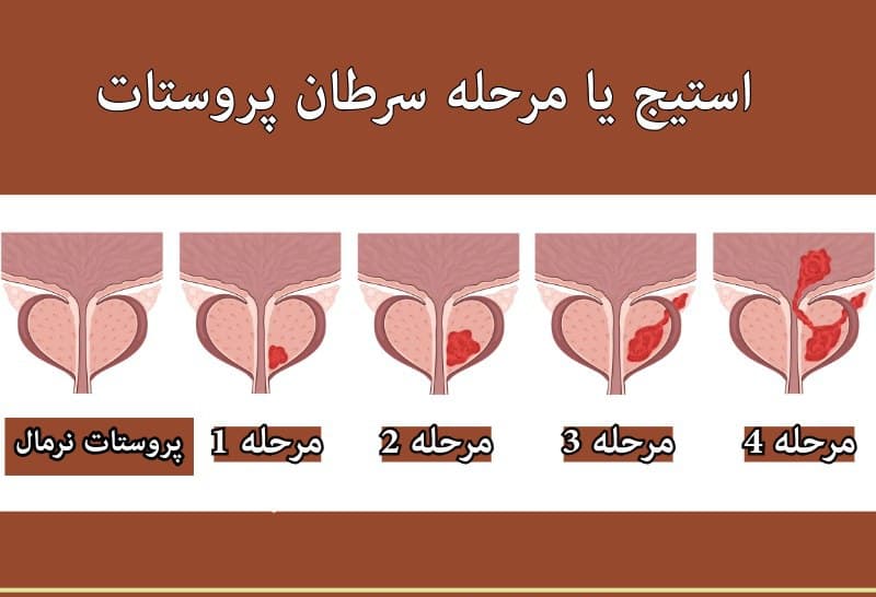 استیج سرطان پروستات