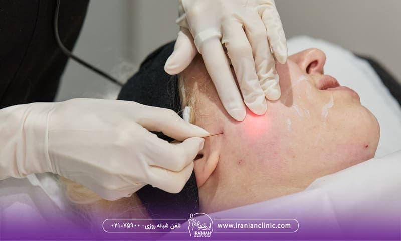 دختری که صورت خود را به یک طرف گرفته است و پزشک میکروفیبر را زیر پوست او فرو کرده است - قیمت اندولیفت