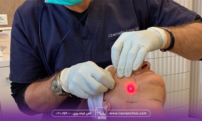 پزشکی که بالای سر مراجعه کننده ایساده و با میکروفیبر دستگاه اندولیفت پوست او را جوانسازی می کند