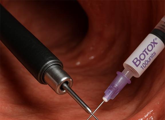 بوتاکس معده