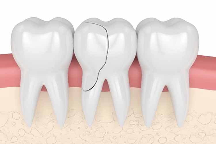 علت ترک دندان