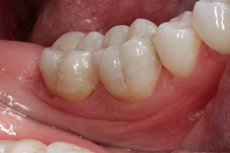 انواع ترک دندان