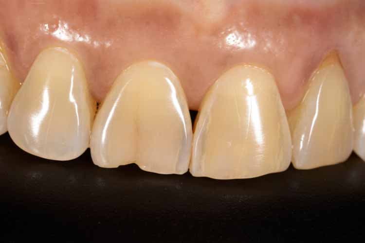 درمان ترک دندان